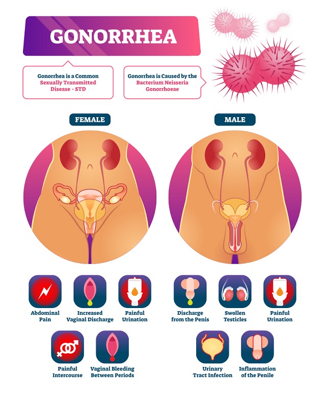 Gonorrhea infographics